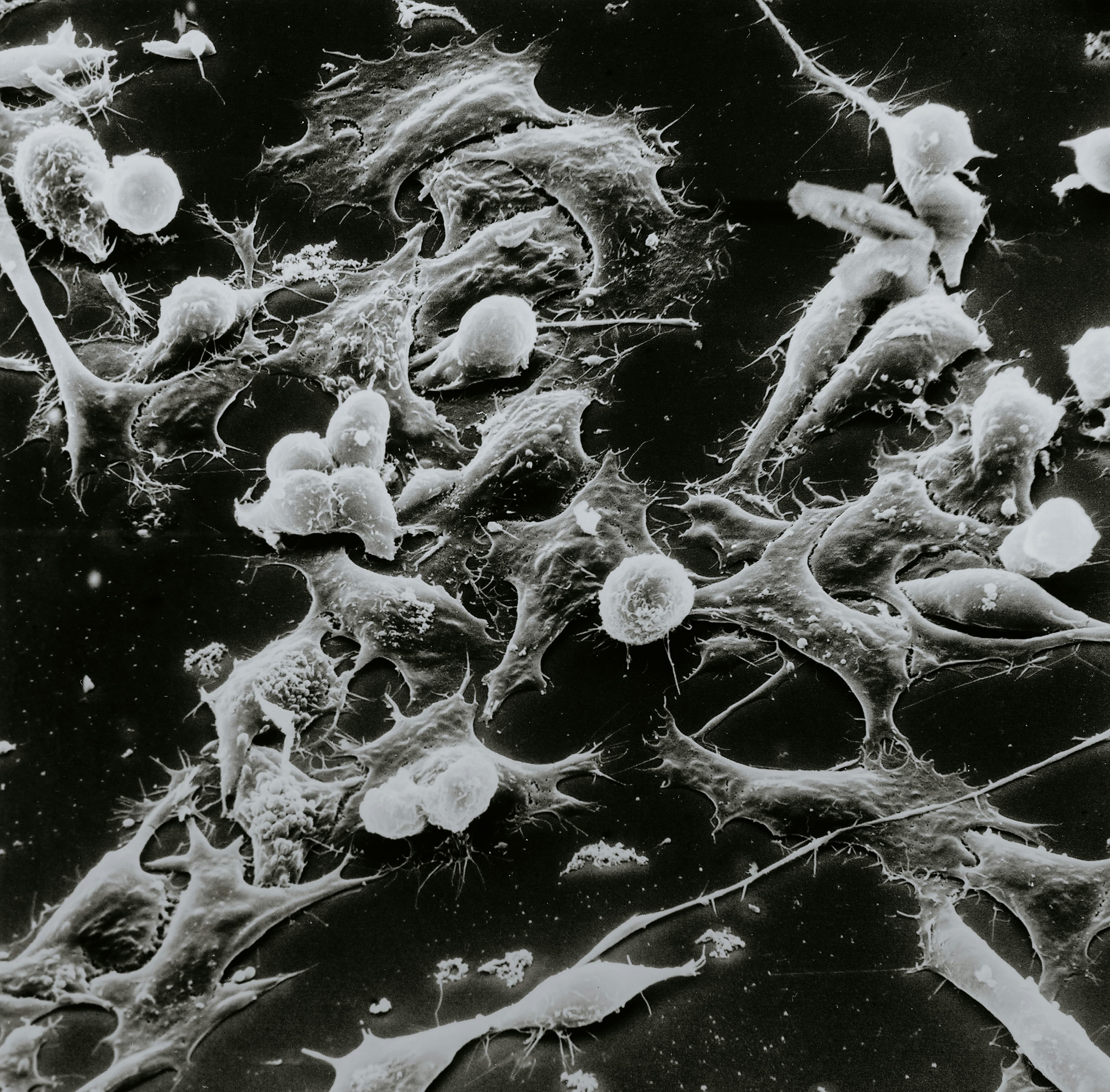Scanning electron microscope image of cancer cells on a dark background